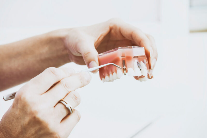 Broken Teeth: Your Guide to Causes, Treatment and Prevention