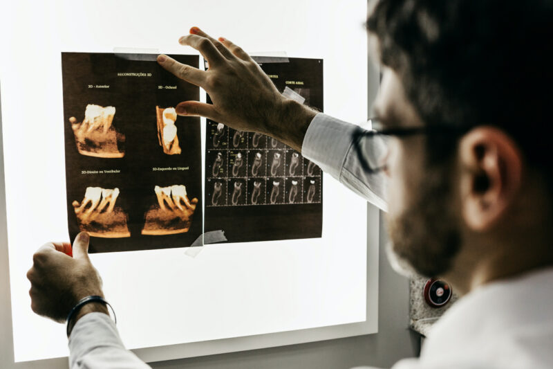 Uncover the Costs of Tooth Extractions in Surrey and Langley